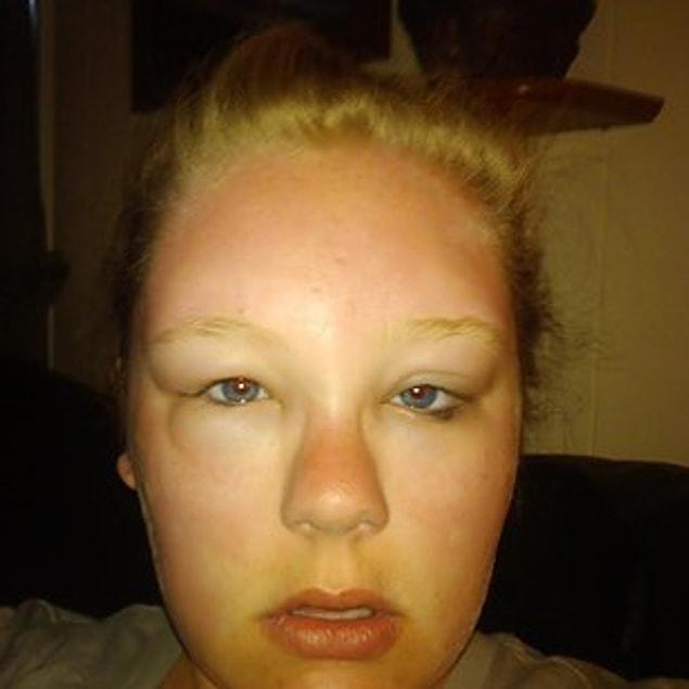 30. This girl who went to Florida and ended up in the hospital instead of on vacation. Sun allergies.