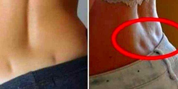 Venus dimples are formed by a short ligament stretching and pulling the skin in towards itself, creating a dimple.