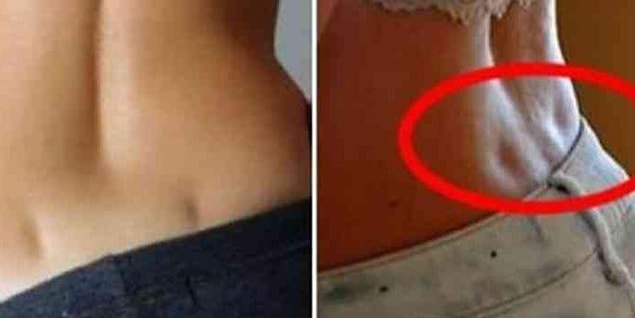 Venus dimples are formed by a short ligament stretching and pulling the skin in towards itself, creating a dimple.