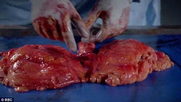 Doctors examine the kidneys. 'If you are obese, some fat will end up in your kidneys and they will have to work harder' one of the doctors said.
