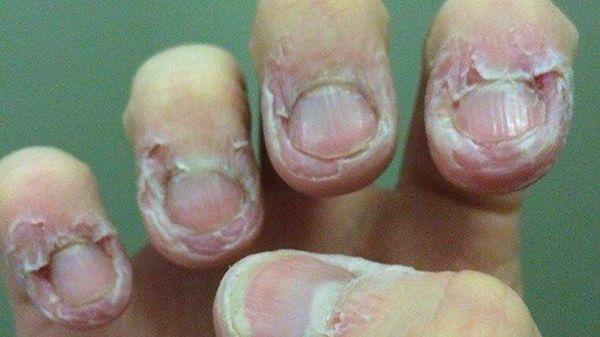 All of a sudden, the skin around your nails start to bleed.