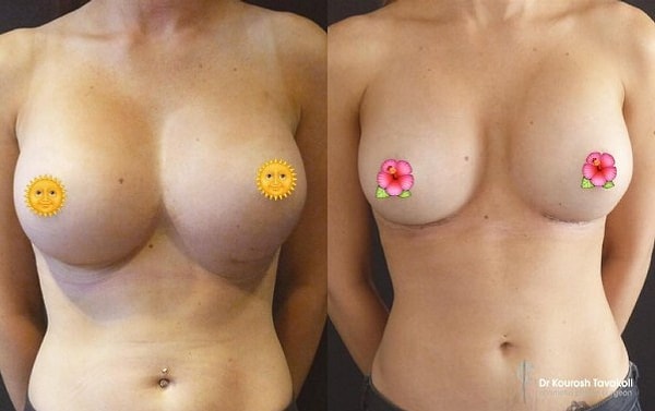 Если почитать комментарии в интернете, складывается впечатление, что Tavakoli действительно очень успешный врач, которому можно доверять.