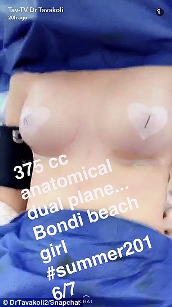 Tavakoli говорит, что благодаря каналу Snapchat ему удалось привлечь новых клиентов, так как после просмотра видео им было легче решиться лечь под нож.