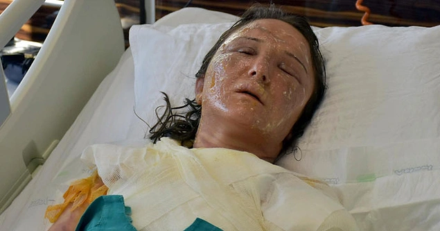Uyuyan Gelininin Yüzüne Kızgın Yağ Döktü Gözaltına Alınıp Serbest Bırakıldı 48