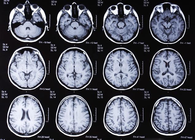 Researchers worked with 900 people and scanned their brains using high precision MRI.
