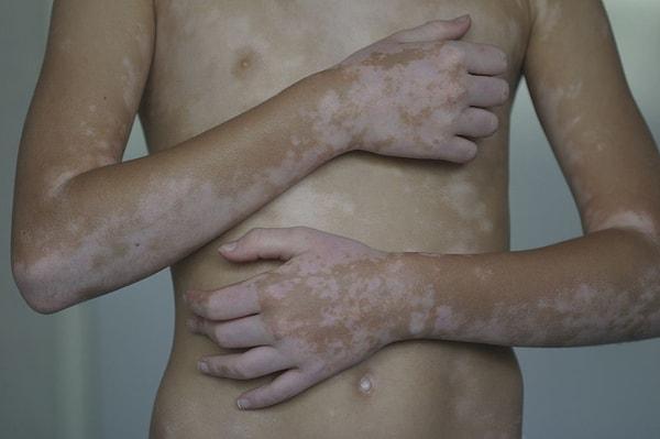 Özetle vitiligo, uzmanlara göre bağışıklık sistemi ve stresin etkileşiminden ortaya çıkıyor gibi görünüyor.