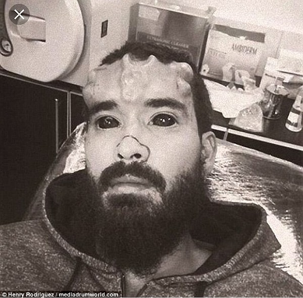 5. Затем он вставил два имплантата под кожу на лбу. Это заняло два года, потому что процесс оказался ступенчатым