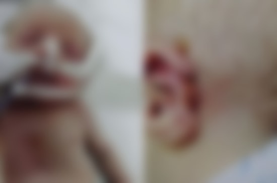 'Yeni Doğan Bebeğin Hastanede Zarar Gören Kulağı Koptu' İddiası...