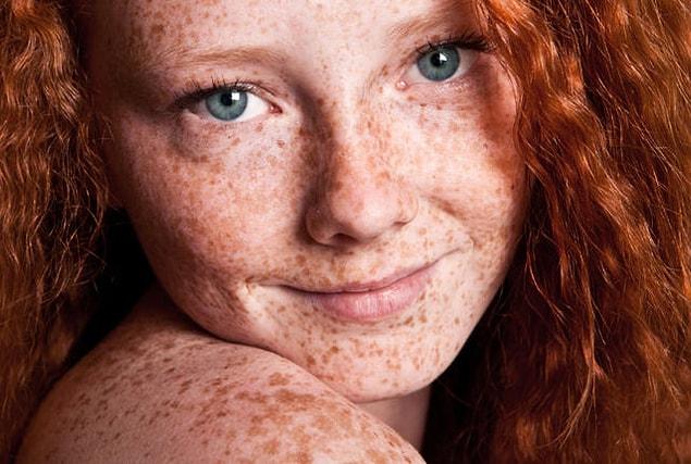 7. Fair skin and freckles