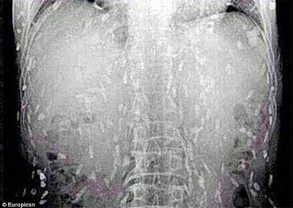 Çinli adam kaşınan bir cilt ve karın ağrısıyla doktoruna gitti. Taramalarda tüm vücudunun tenyalarla kaplı olduğu ortaya çıktı.