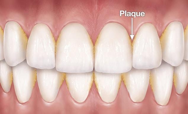 There are millions of bacteria in our mouth, but the ones that cause plaque are a bit different than the rest. Plaque, which is basically a biofilm, is difficult to get rid of after it sticks to the tooth.