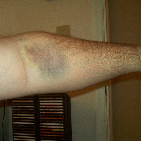 18. Предполагается, что ваш лечащий врач или медсестра достаточно квалифицированы, чтобы нащупать вену с первого раза.