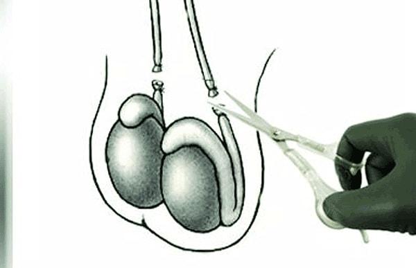 Vasektomi, spermleri üretraya (idrar yolu) ileten kanal olan vas deferensin kesilip bağlanmasıyla gerçekleştiriliyor.
