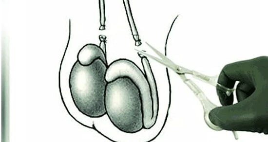 Bu Kez de Vasektomiye Kardeş Geliyor! Sperm Kanalına Enjekte Edilen Az Yan Etkili Jel