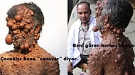 Bütün Vücudunu Kaplayan Tümörlerle Yaşamaya Çalışan 47 Yaşındaki Adam