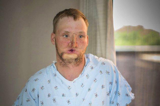 Sandness, hastaneye kaldırıldığında burnu ve çenesi neredeyse yok olmuştu.  Sol gözünde bir miktar görme kaybı vardı.