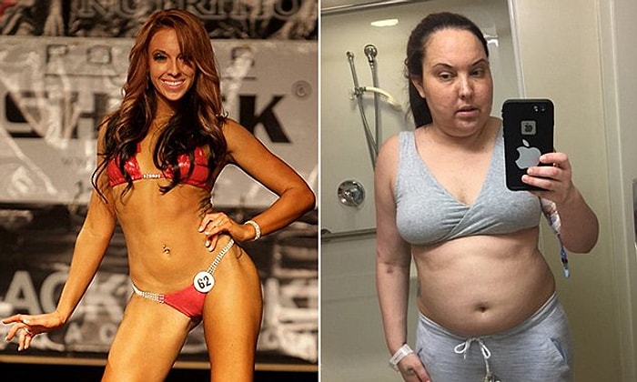 Beynindeki Tümör Yüzünden 18kg Alan ve Sağlık Mücadelesinden Vazgeçmeyen Bikini Modeli