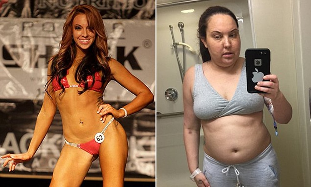 Beynindeki Tümör Yüzünden 18kg Alan ve Sağlık Mücadelesinden Vazgeçmeyen Bikini Modeli