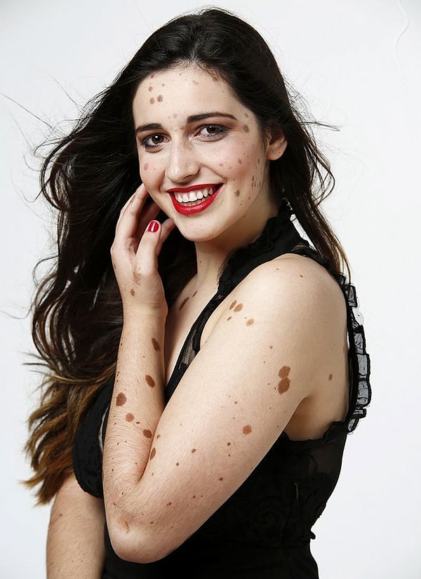 2. Она страдает от редкой формы меланоцитарного невуса, что означает, что все ее тело покрыто крупными родинками и большими темными участками волосистой кожи