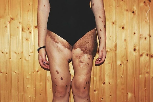 6. После нескольких лет отчаянной борьбы со своей неуверенностью, Альба решила поделиться с миром своей историей и показать свою кожу