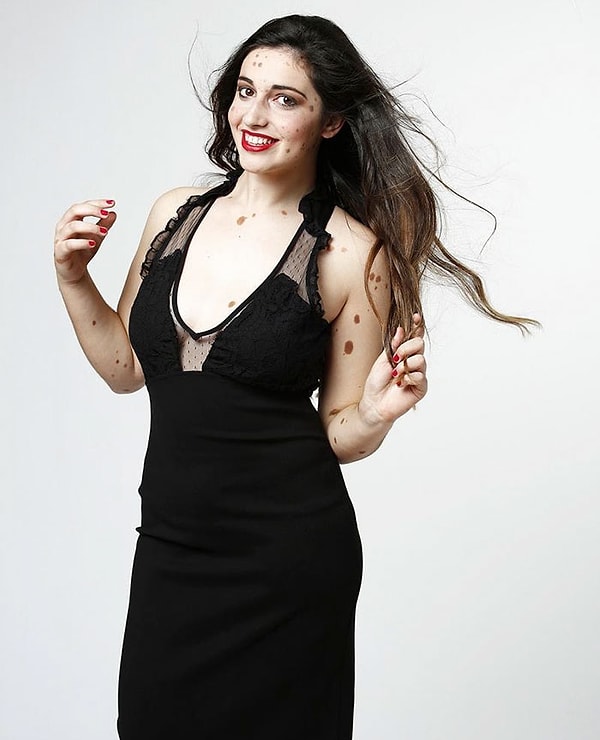 10. "Невус — моя идентичность, и благодаря ему я встретила много фантастических людей", — говорит она