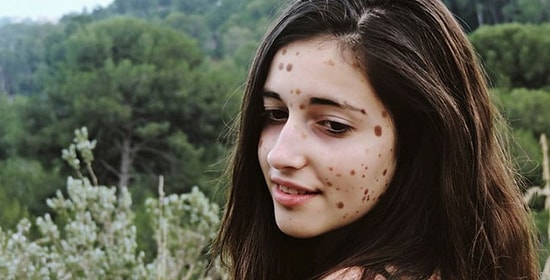 У этой девушки 500 родинок, ее дразнили и унижали, но вы только взгляните на нее сейчас