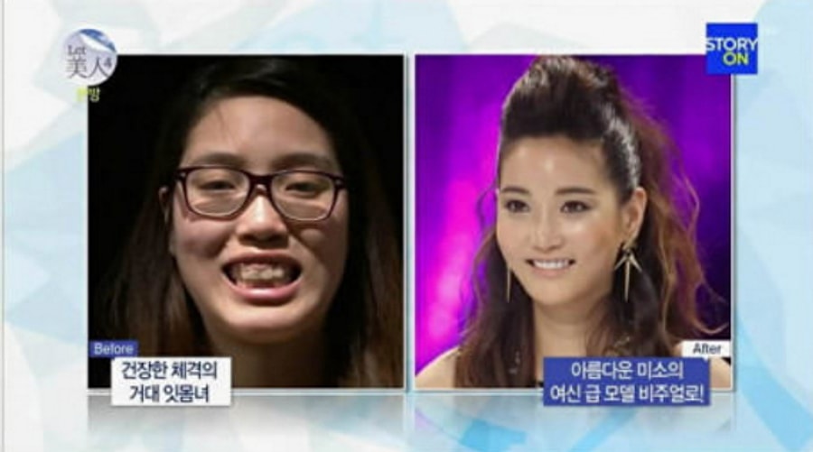 19 Mind Blowing Before And After Faces From South Korea's Plastic