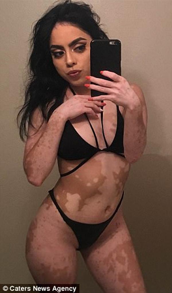 Ashley Soto 21 yaşında ve çocukluğundan beri vücudunda vitiligo yüzünden beyaz lekeler oluşuyor.