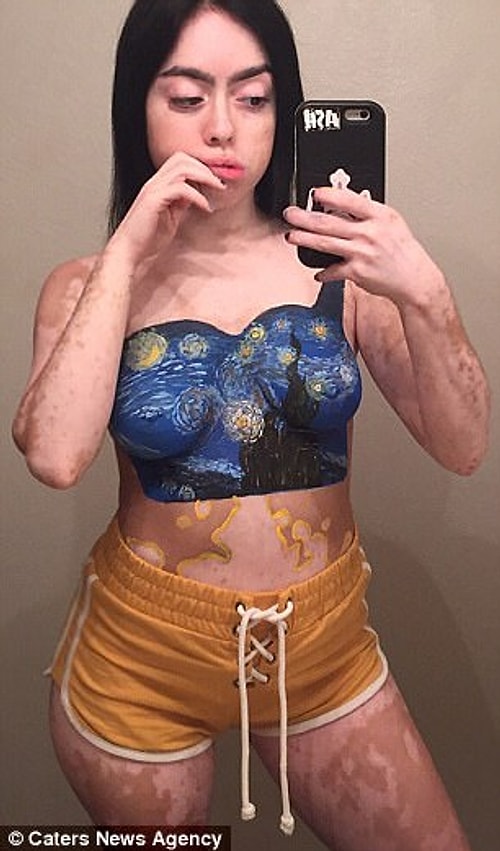 Ashley Soto 21 yaşında ve çocukluğundan beri vücudunda vitiligo yüzünden beyaz lekeler oluşuyor.