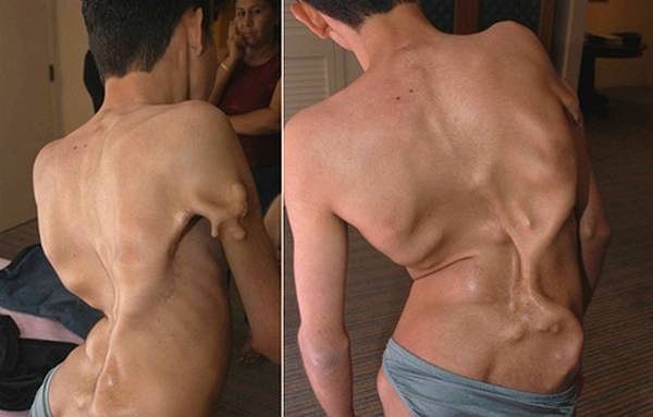 2. Фибродисплазия