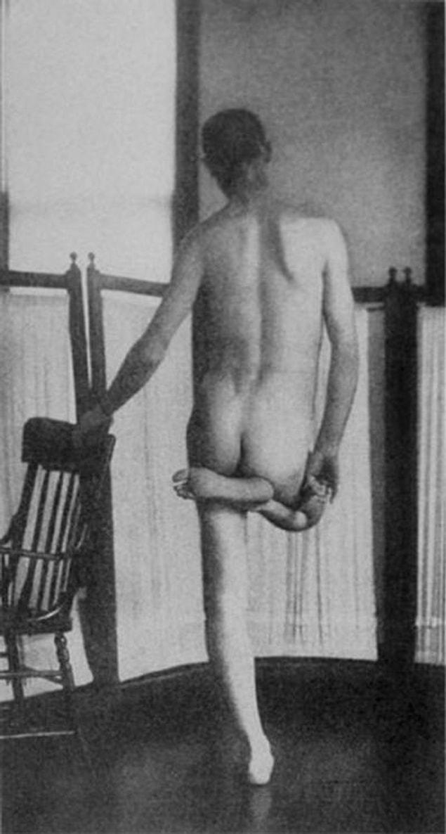 7. A chronic schizophrenic patient stands in a catatonic position. He maintained this uncomfortable position for hours.