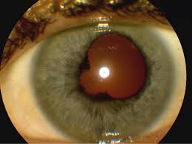 The iris collarette is a thick membrane surrounding the pupil, although it's not seen very clearly.