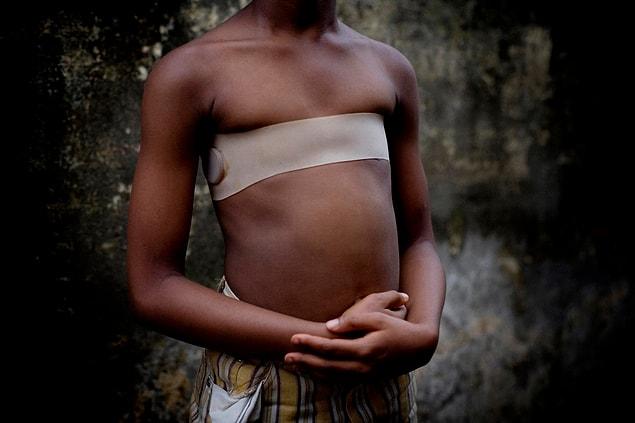 Breast Ironing is another medieval torture besides circumcision for women and especially for girls.