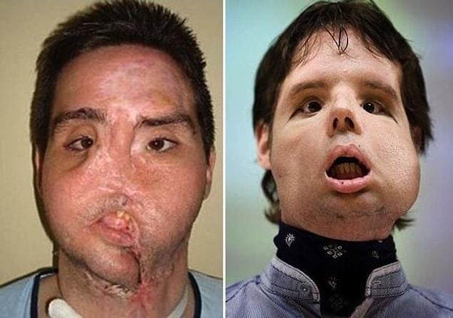 4. This man, known only as Oscar, is a Spanish farmer who accidentally shot himself in the face. He received a full-face transplant in 2010.