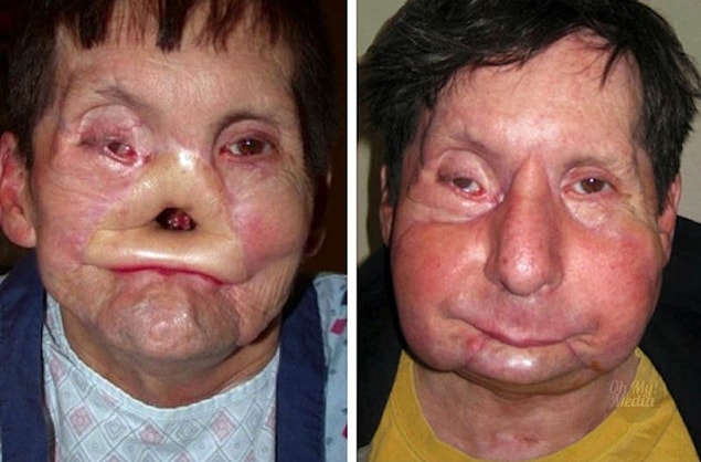 7. James Maki, of Massachusetts, was horribly injured after falling face first onto an electrified subway rail. He received a nearly full-face transplant in 2009.