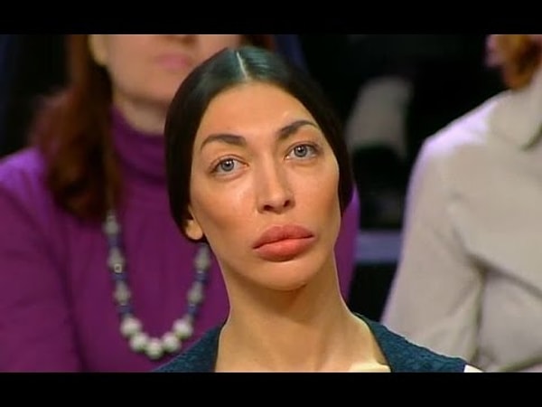 2. Девушка призналась, что с самого детства мечтала о пластике.