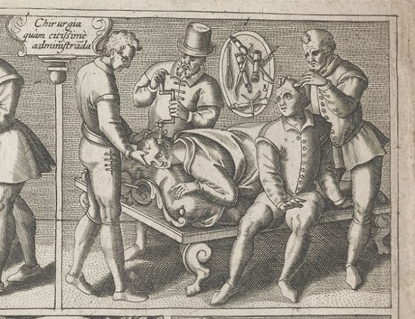 3. Трепанация