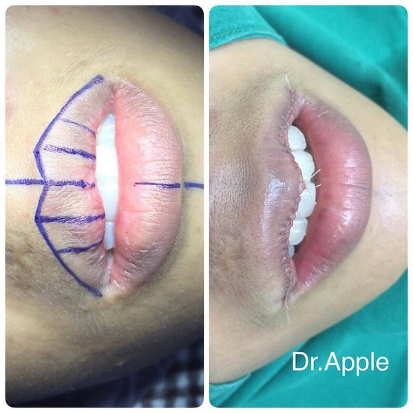 4. Между прочим, такая операция стоит даже дороже, чем увеличение губ! Например, в Москве увеличение стоит около тысячи долларов, в то время как уменьшение губ - от 2 000 до 11 500 долларов.