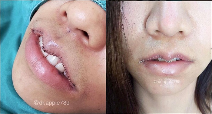 Ушивание губ: новый сумасшедший тренд набирает обороты😱