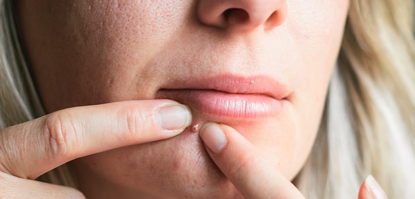 14. Вы получаете удовольствие от выдавливания прыщей?