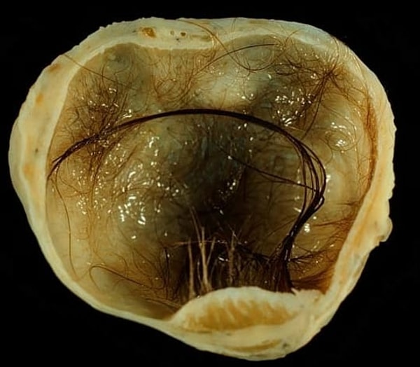 14. Некоторые опухоли имеют зубы, волосы и даже собственные органы