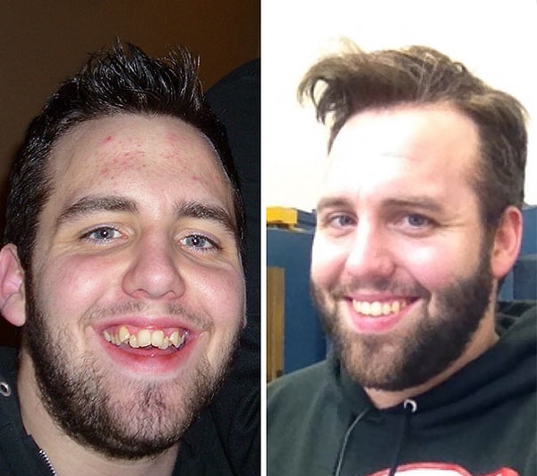 2. "Моя семья не могла позволить поставить мне брекеты, поэтому, когда я нашел работу и получил страховку, это было первое, что я сделал"