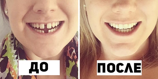 20 фото "До и После" брекетов, доказывающих что красивая улыбка меняет все