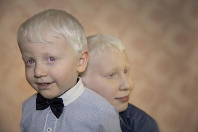 Dünya Albinizm Günü Anısına Türkiye’nin Beyaz Melekleri “Albinolar” Fotoğraf Projesi