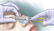 Olur da Diziniz Kırılırsa Eğer Doktorlar Kıkırdağı Başka Yerden Değil, Burnunuzdan Alacaklar!