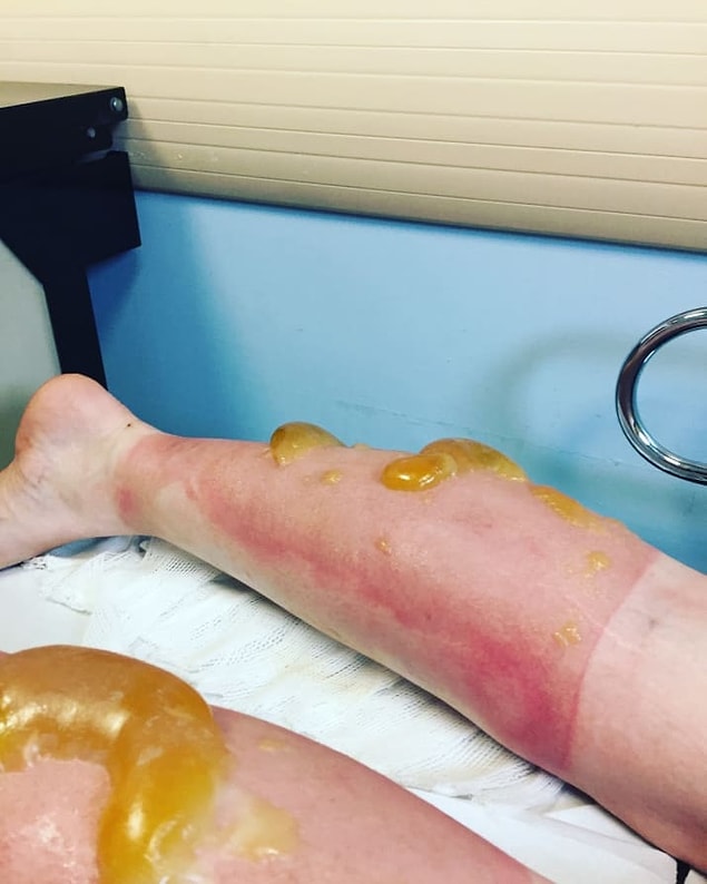 Doktor Whitney Bowe'un söylediğine göre maraton koşucuları sık sık ciddi güneş yanıkları yaşıyorlar.