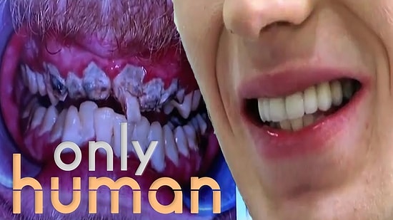 Hayatında Dişlerini Hiç Fırçalamayan Gencin 20 Yılın Sonunda Sahip Olduğu Yeni Gülüşü