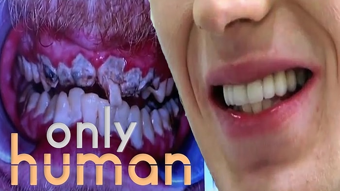 Hayatında Dişlerini Hiç Fırçalamayan Gencin 20 Yılın Sonunda Sahip Olduğu Yeni Gülüşü