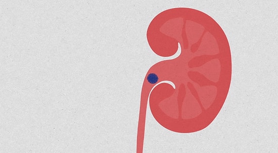 Böbrek Taşlarına Ne Sebep Olur?