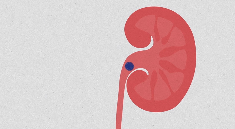 Böbrek Taşlarına Ne Sebep Olur?